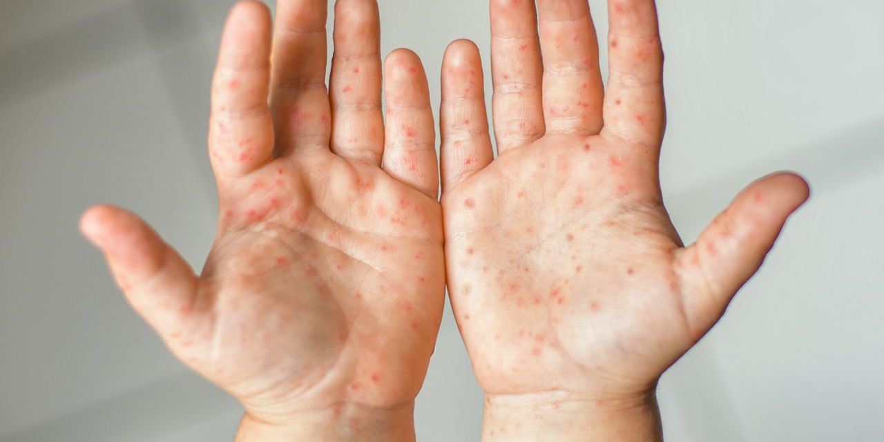 Coxsackievirus Flu Ringan Hingga Penyakit Tangan, Kaki & Mulut