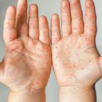 Coxsackievirus Flu Ringan Hingga Penyakit Tangan, Kaki & Mulut