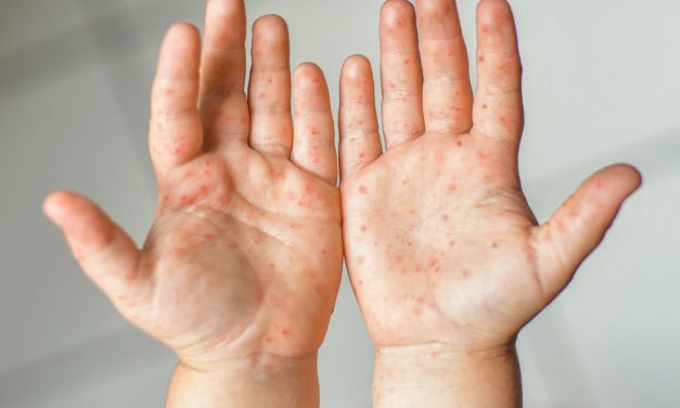 Coxsackievirus Flu Ringan Hingga Penyakit Tangan, Kaki & Mulut